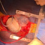 ‘I Felt Like I Was in the Future’: Israeli Team Replaces Entire Human Heart