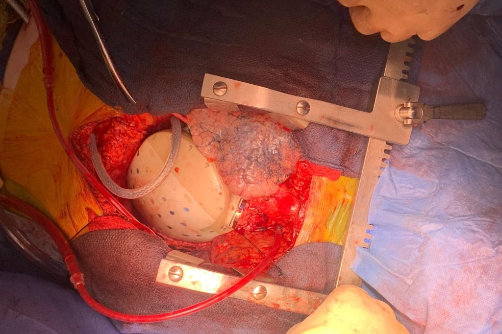 ‘I Felt Like I Was in the Future’: Israeli Team Replaces Entire Human Heart