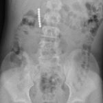 12-Year-Old Undergoes Emergency Surgery After Swallowing Magnetic Balls