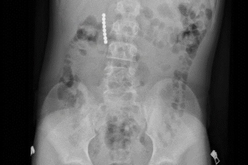 12-Year-Old Undergoes Emergency Surgery After Swallowing Magnetic Balls